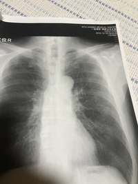 肺ガン闘病記